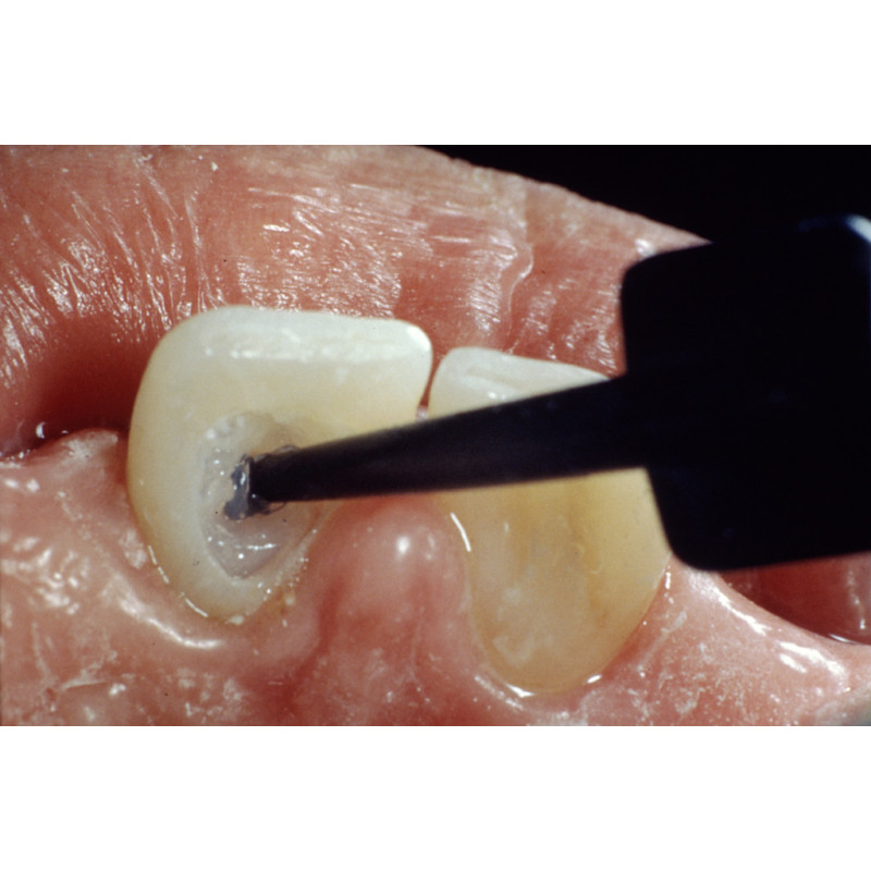 OPALESCENCE ENDO KIT